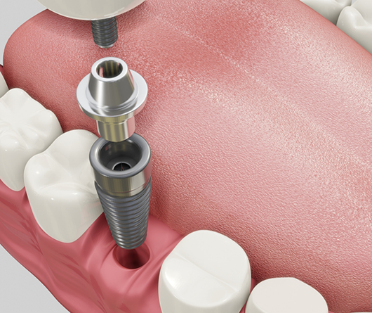 Diagram of a tapered dental implant replacing a lost tooth