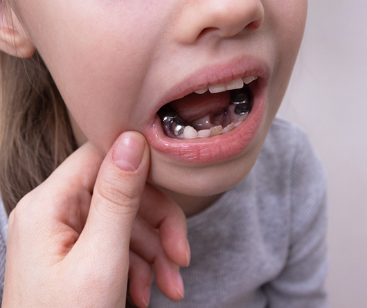 Child with silver on a few of their back teeth