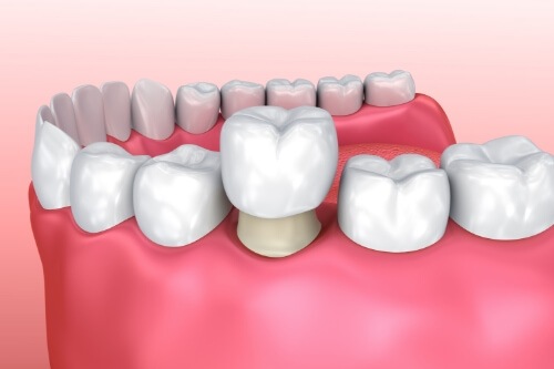 Illustrated dental crown being fitted onto a tooth