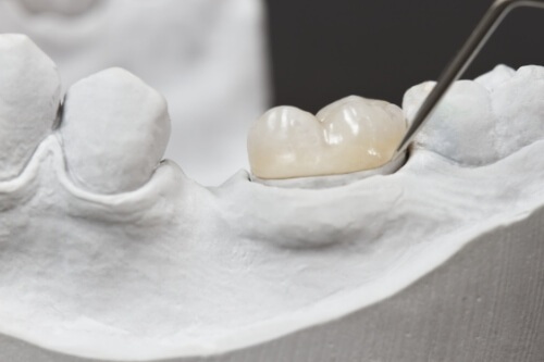 Dental crown over a tooth in a model of the mouth