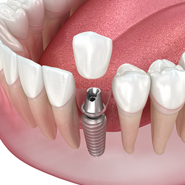 Diagram of a dental crown covering a dental implant