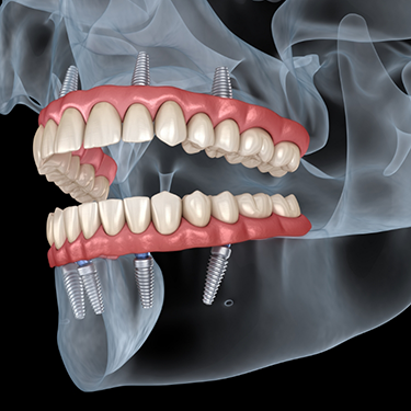 Diagram of a person with implant dentures replacing all teeth