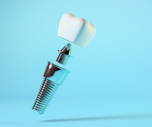 Diagram of the parts of a dental implant on a pale blue background