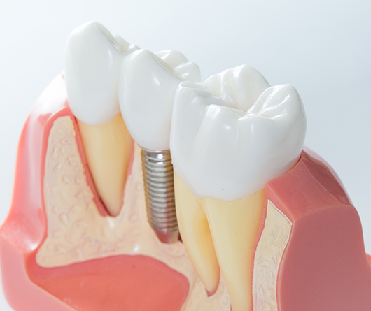 Model of a dental implant between two natural teeth