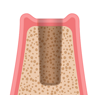 Diagram of an empty socket after tooth loss