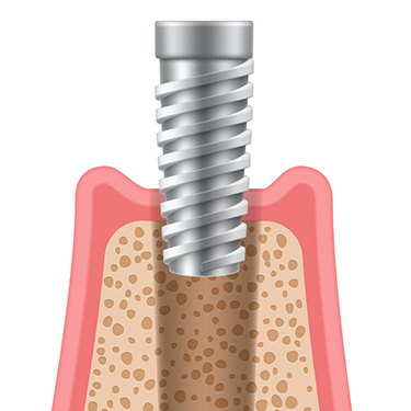Diagram of a dental implant post placed into the socket
