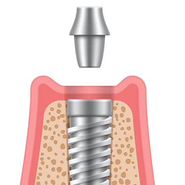 Diagram of an abutment placed on top of the implant