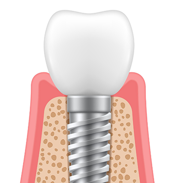 Diagram of a dental implant with a dental crown on top