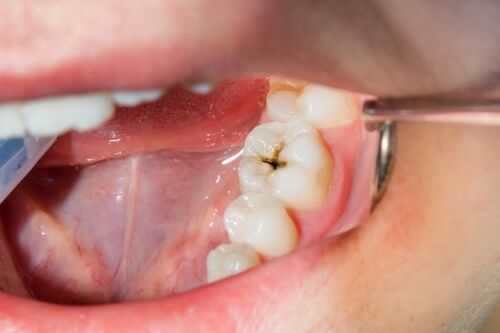 Close up of mouth with a decayed tooth