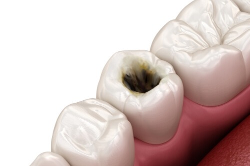 Illustrated tooth with a cavity