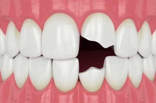 Illustrated mouth with two chipped teeth
