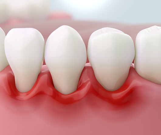Illustration of a mouth with gum recession