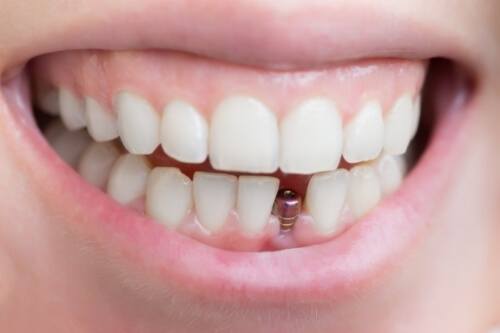 Close up of smile with visible dental implant
