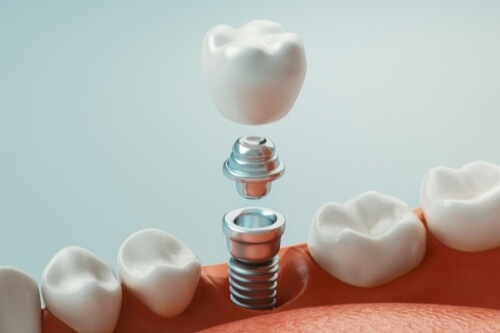 Illustrated dental implant with crown being placed in lower jaw