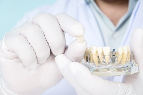 Dentist holding a dental crown in one hand and a dental implant model in the other