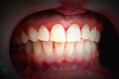 Close up of mouth with red inflamed gums