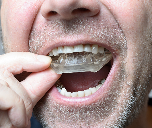 Man placing a clear nightguard tray over his teeth