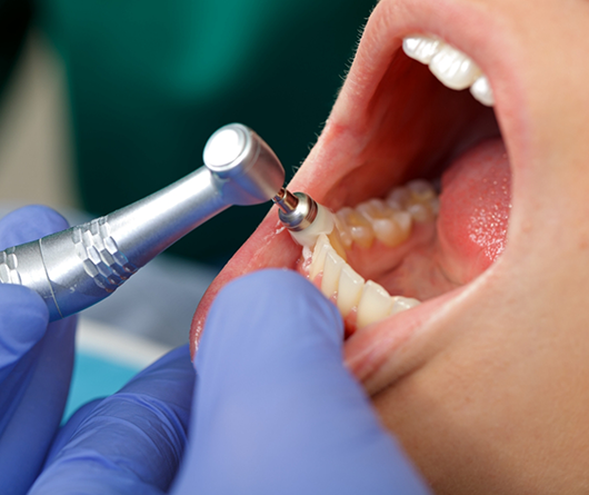 Dental patient having their teeth cleaned