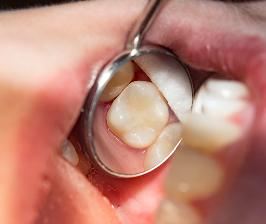 Dental mirror in a mouth reflecting a flawless tooth