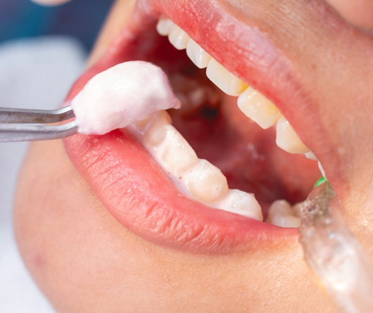Dental patient having a white paste applied to their teeth