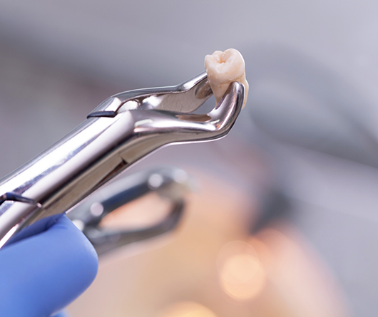 Forceps holding an extracted tooth