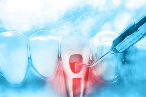 Illustrated dental instrument treating the inside of a tooth