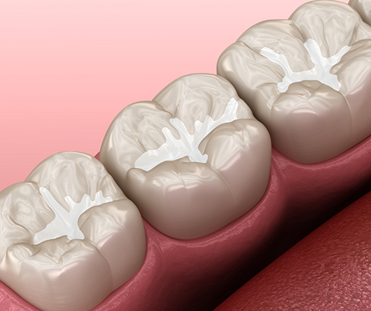 Illustration of teeth with white fillings