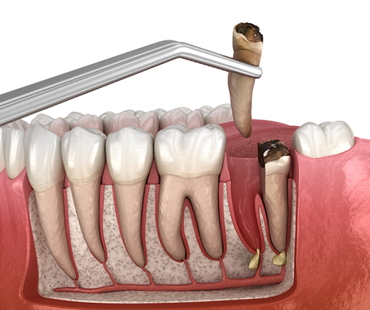 Illustration of a tooth being extracted