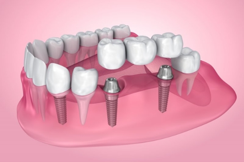 Illustrated tooth with a cavity