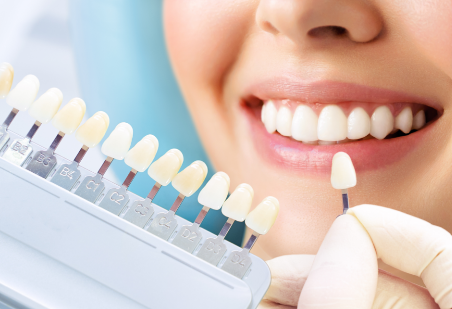 Close up of woman's smile and veneers in dentist's hand