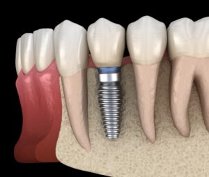 Computer rendering of dental implant shown in the mouth.