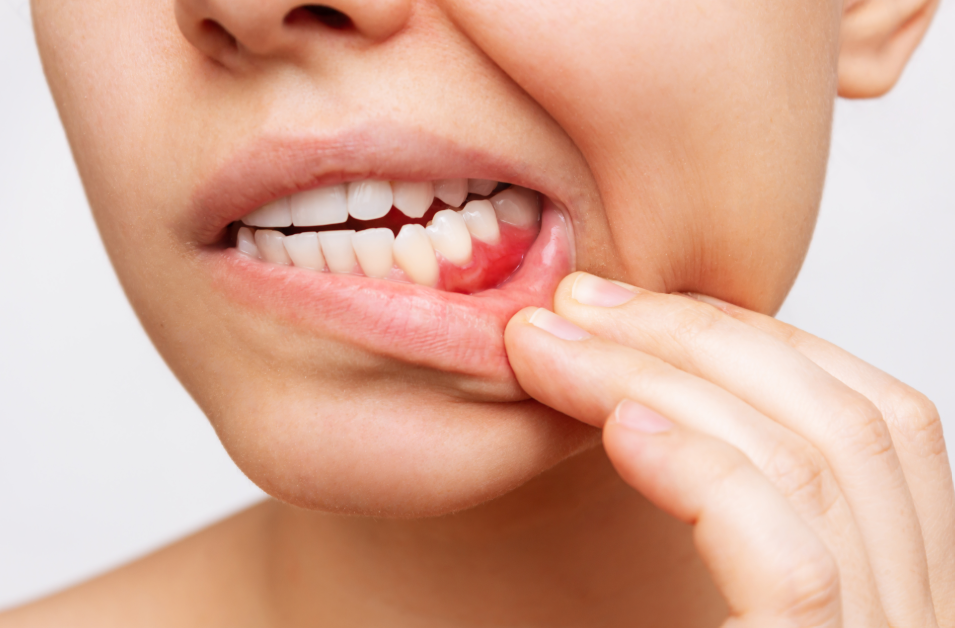 Close up of woman's mouth with inflamed gums